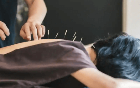 Acupuncture Services